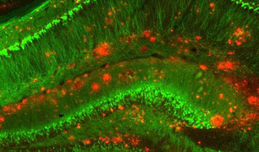 Cholesterin im Gehirn beschleunigt die Plaquebildung bei Alzheimer