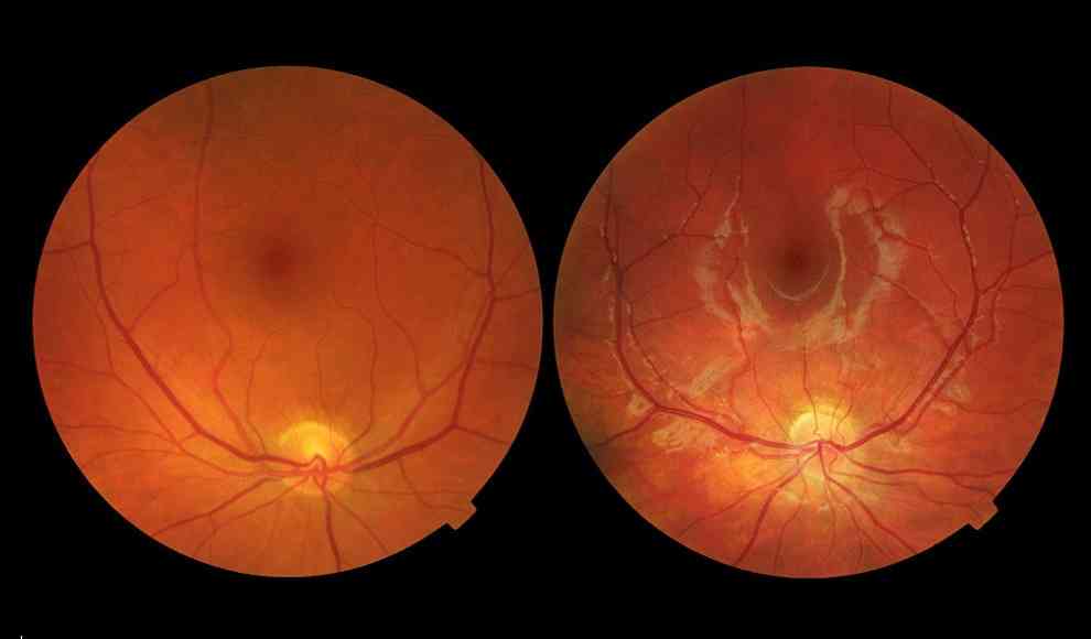 gesundes Auge (link) und Makuladegeneration (rechts) 