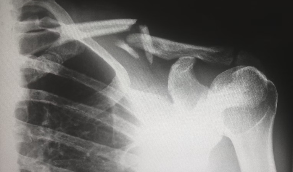 Röntgenbild einer Knochenverletzung